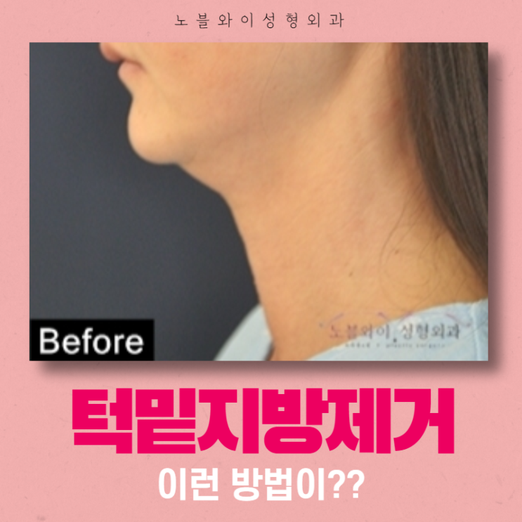  턱밑지방제거 흡입말고 이런 방법이 있네