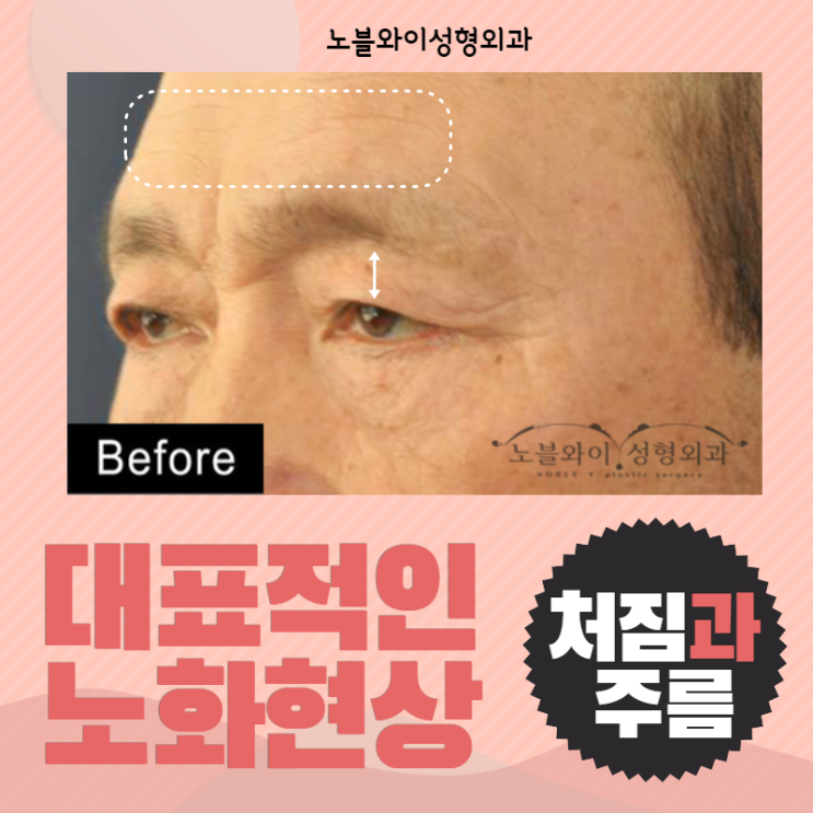  이마거상수술 처진눈꺼풀과 이마주름 동시에