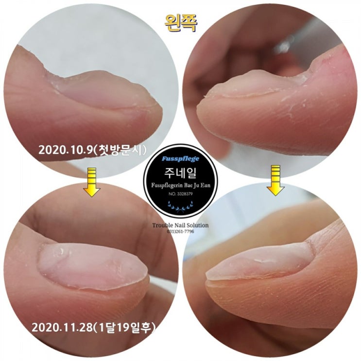 25년동안의 울퉁불퉁한 손톱에서 50일만에 벗어났습니다. (정중조갑이영양증)/분당용인수원수지보정동백죽전동/주네일/무좀파고드는내향성발톱손톱변형전문네일살롱 25년동안의 울퉁불퉁한 손톱에서 50일만에 벗어났습니다. (정중조갑이영양증)/분당용인수원수지보정동백죽전동/주네일/무좀파고드는내향성발톱손톱변형전문네일살롱
