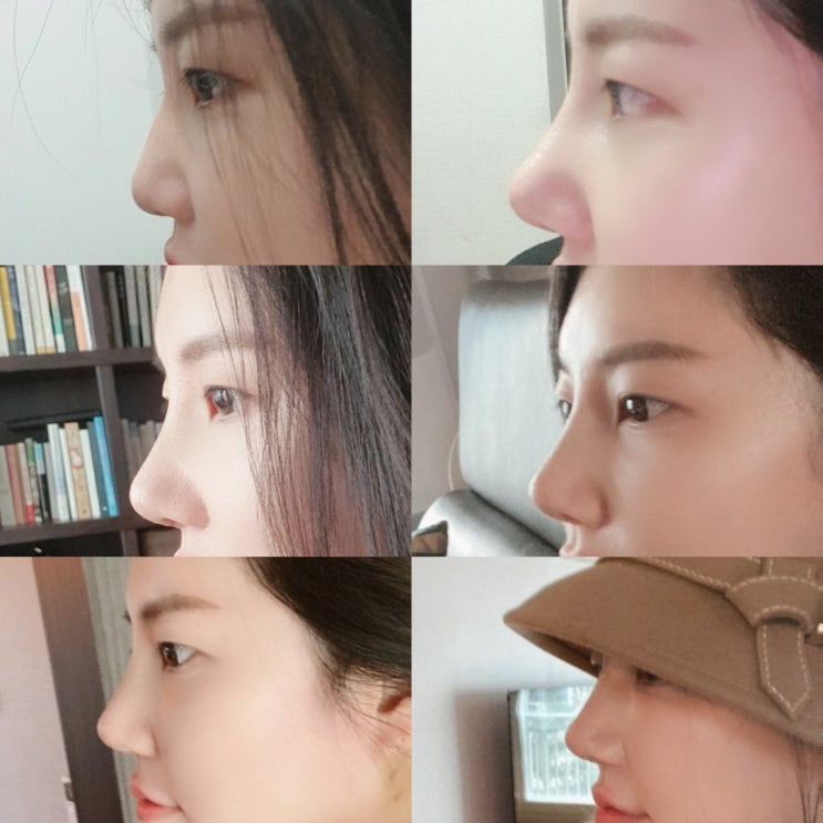 코수술 +13일차 (복코수술 후기)