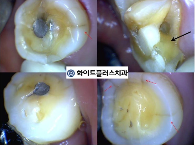  (신길동/신대방동 치과) 충치보다 무서운 치아 마모