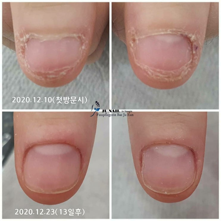 물어뜯는손톱 2주간 관리후기(이거실화임)/분당용인수원수지보정동백죽전동/주네일/무좀파고드는내향성발톱손톱변형전문네일살롱 물어뜯는손톱 2주간 관리후기(이거실화임)/분당용인수원수지보정동백죽전동/주네일/무좀파고드는내향성발톱손톱변형전문네일살롱