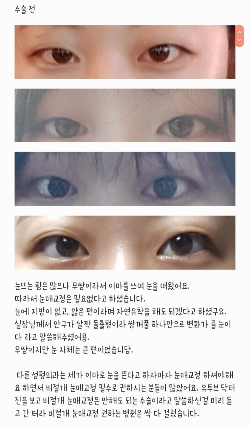 쌍수 2주 및 완벽 후기 : 네이버 블로그