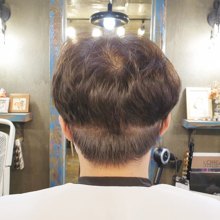  터키 모발이식 후 두 번째 뒷머리