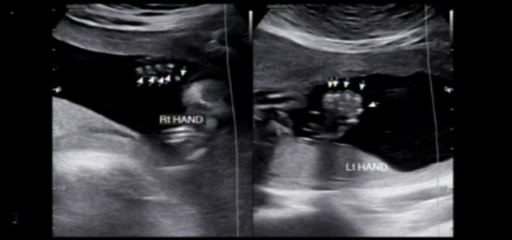 남편이 쓰는 임신일기 [11] (임신 20주 - 정밀초음파 검사)