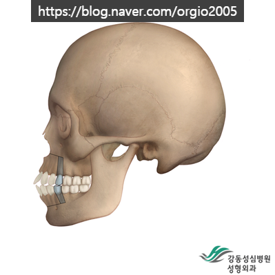  돌출입 수술> 돌출입 수술은 양악수술이 아닙니다. (feat. 미니양악??)