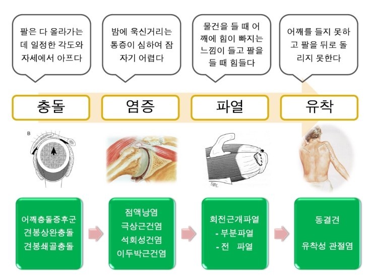 안양한의원 - 어깨통증(오십견, 동결어깨, 석회성건염, 회전근개파열 등)