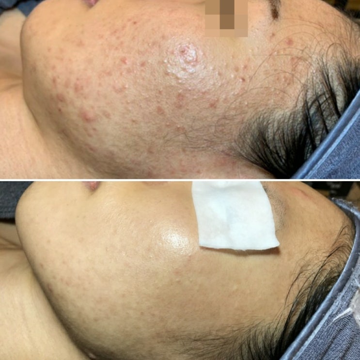  피부 오돌토돌좁쌀여드름, 잘 안없어지는 건조한 좁쌀여드름관리는 구로디지털단지 여드름전문관리실 하이스킨!