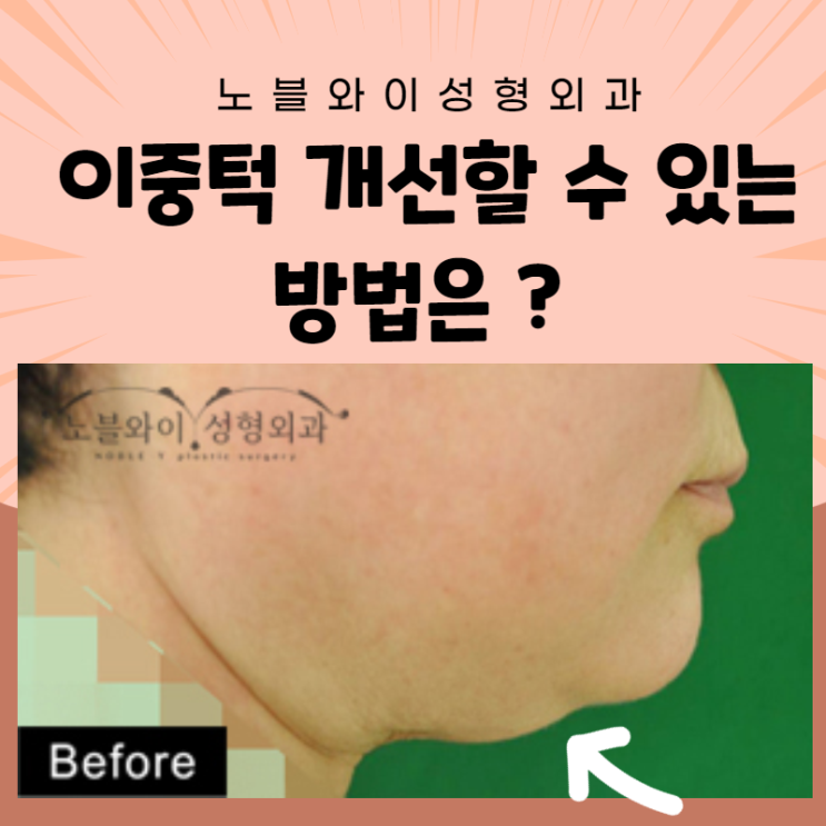  노블와이성형외과 이중턱수술 깔끔하네