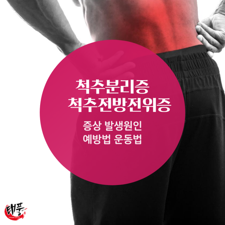  척추분리증 척추전방전위증 증상, 발생 원인, 예방 운동법