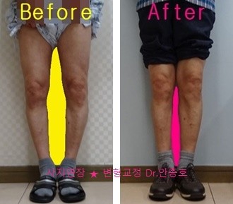 다리휘어짐을 조기치료해야 하는 경우