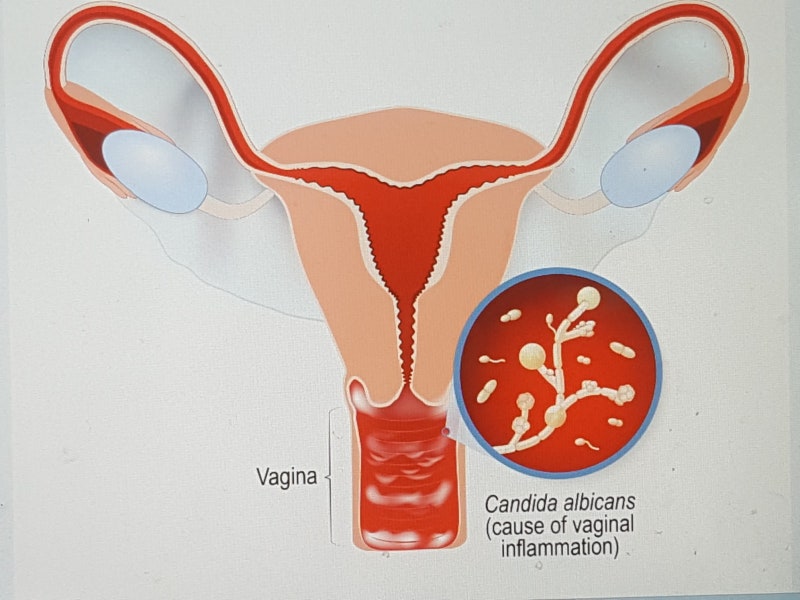 질 하얀덩어리(흰색 덩어리냉) 나온다면? 질내 곰팡이 번식 가능성 높아요 : 네이버 블로그 질 하얀덩어리(흰색 덩어리냉) 나온다면? 질내 곰팡이 번식 가능성 높아요 : 네이버 블로그
