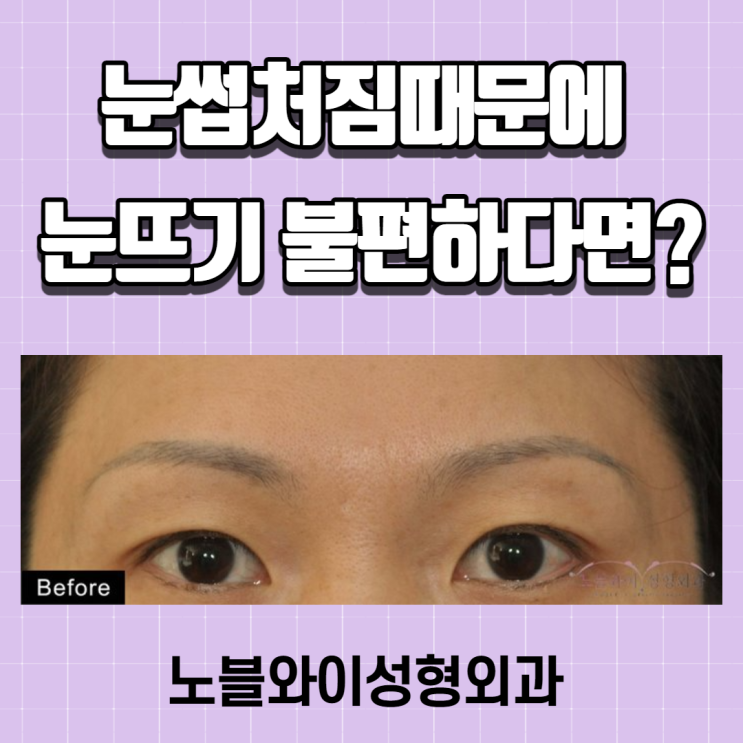  내시경이마거상술후기 눈매가 또렷해지네요