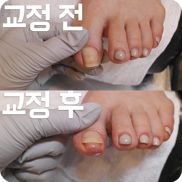 스트레스 해소를 위한 대구 자란 발톱 6