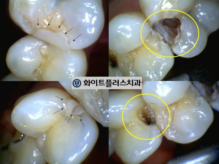  보라매역 치과, 틈새가 벌어진 레진에 충치 - 이차우식