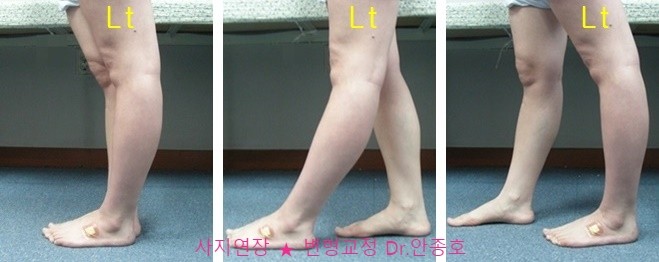 전반슬 백니 (back knee) 증상