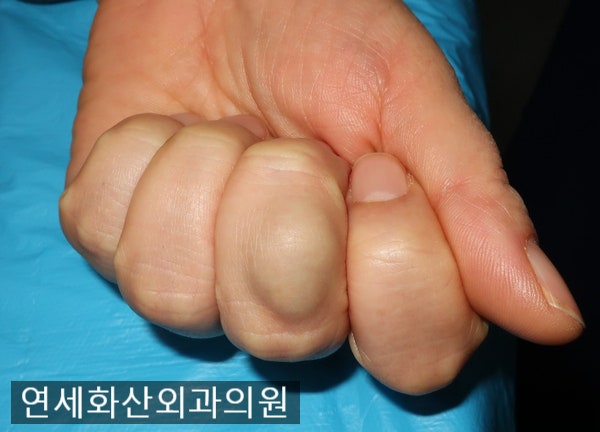 [송파 피부종양 수술] 손가락에 2
