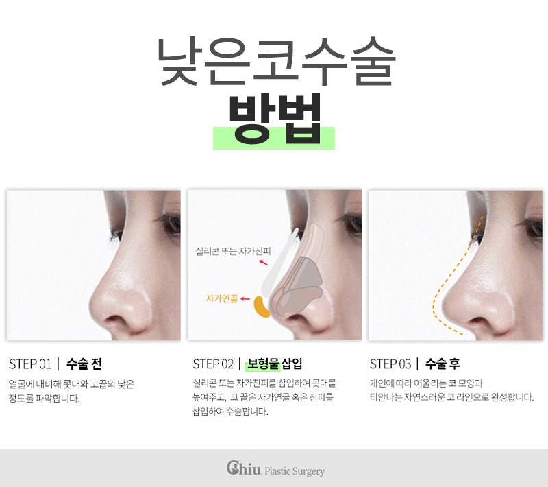 낮은코수술후기 ( 코높이도2배!! 자신감도2배!! 자연스러움도2배!! ) : 네이버 블로그 낮은코수술후기 ( 코높이도2배!! 자신감도2배!! 자연스러움도2배!! ) : 네이버 블로그