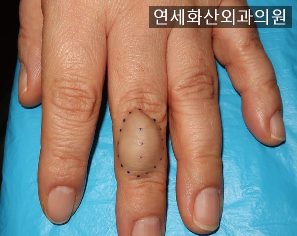 [송파 피부종양 수술] 손가락에 5