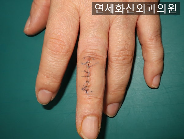 [송파 피부종양 수술] 손가락에 7