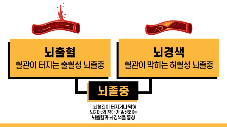  [Q&A로 풀어보는 건강상식] 뇌졸중 초기 증상과 예방법, 치료방법과 치료 비용까지