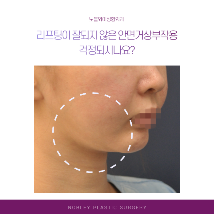  안면거상부작용 걱정된다면 안면거상술잘하는곳에서