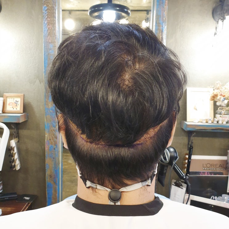  정수리모발이식 후두부 확인했나요?