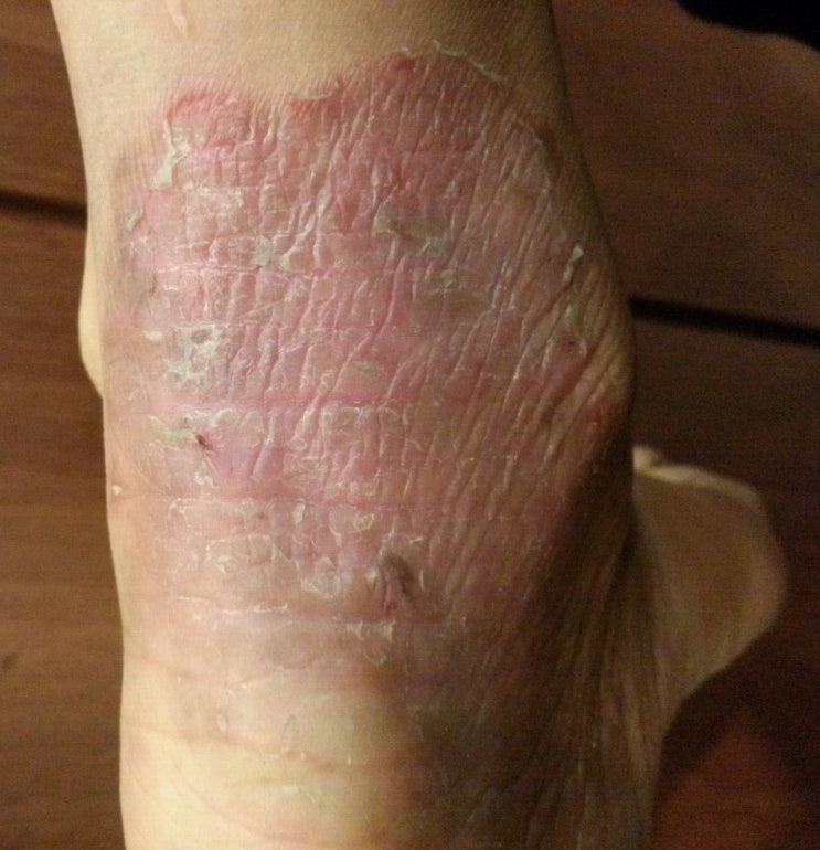  발목 한포진 정상 되었습니다:(고객실제후기)