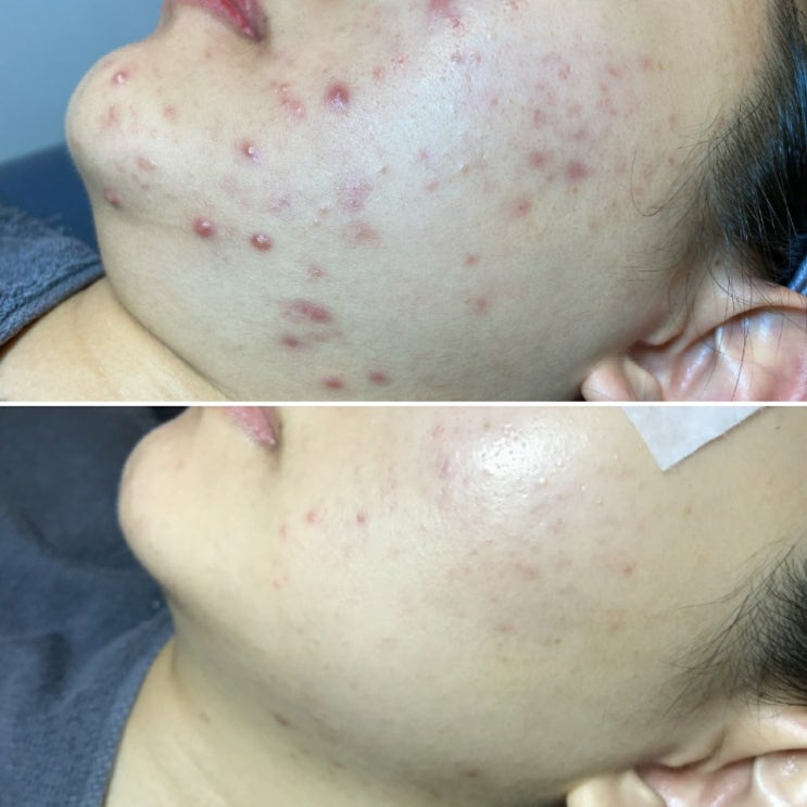  턱화농성여드름, 턱염증성여드름, 턱드름, 턱마스크트러블은 여드름전문관리실 하이스킨