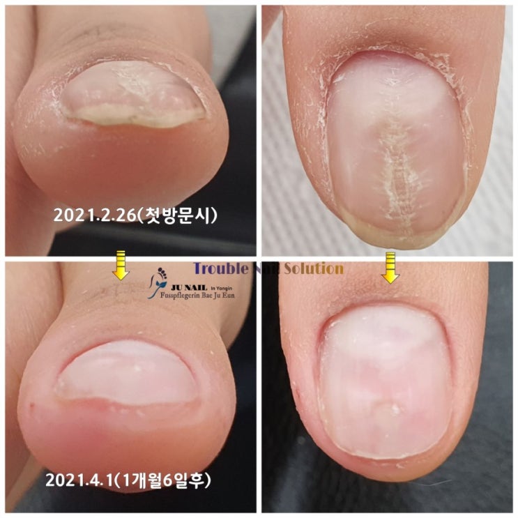 잠실에서오셨어요. 엄지손톱변형 약1달 2회 관리후 후기/성남수원수지보정동백죽전동/주네일/무좀파고드는내향성발톱손톱변형전문점 잠실에서오셨어요. 엄지손톱변형 약1달 2회 관리후 후기/성남수원수지보정동백죽전동/주네일/무좀파고드는내향성발톱손톱변형전문점