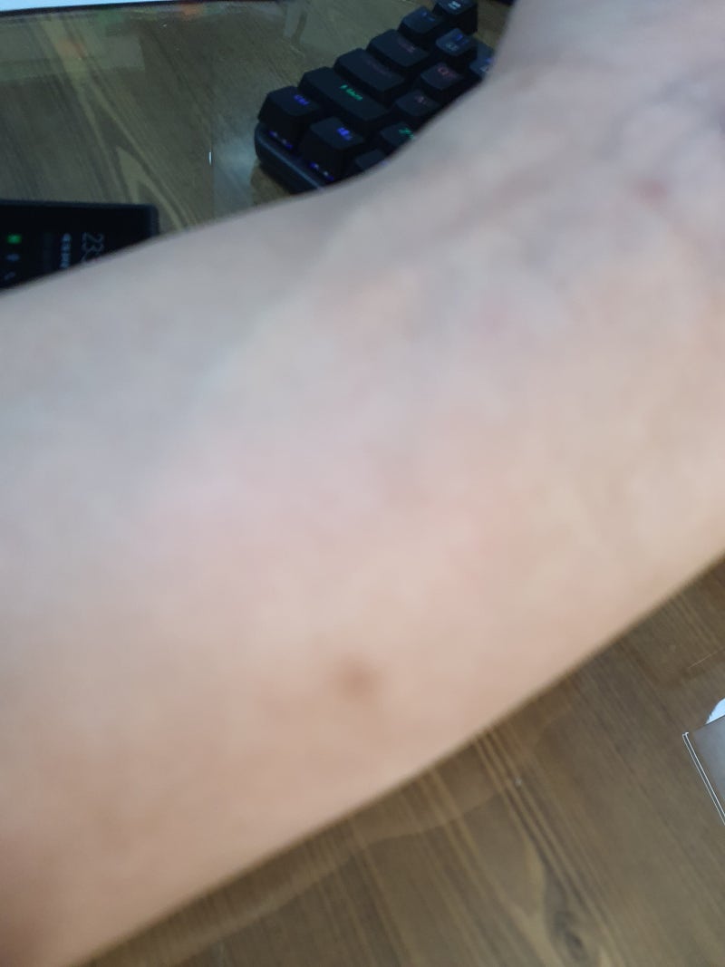 권연벌레 물린 자국 물림 원인 권연침벌 퇴치해요 : 네이버 블로그 권연벌레 물린 자국 물림 원인 권연침벌 퇴치해요 : 네이버 블로그
