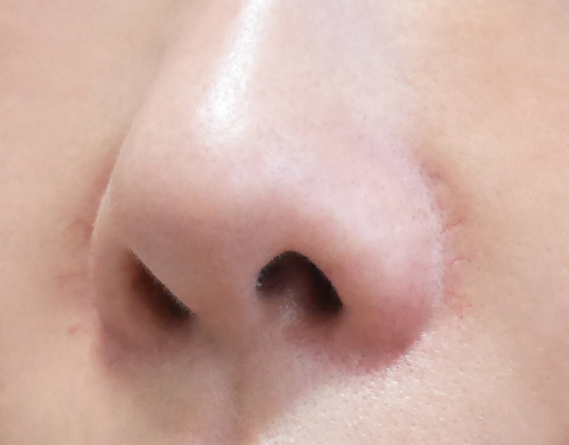 코 양쪽 여드름의 꼼꼼한 간호에 대한 고찰