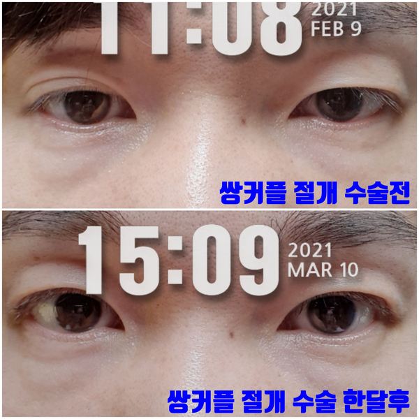  남자 쌍커플 수술 절개 비절개 고민 한방에 해결했어요(실제시술후기)