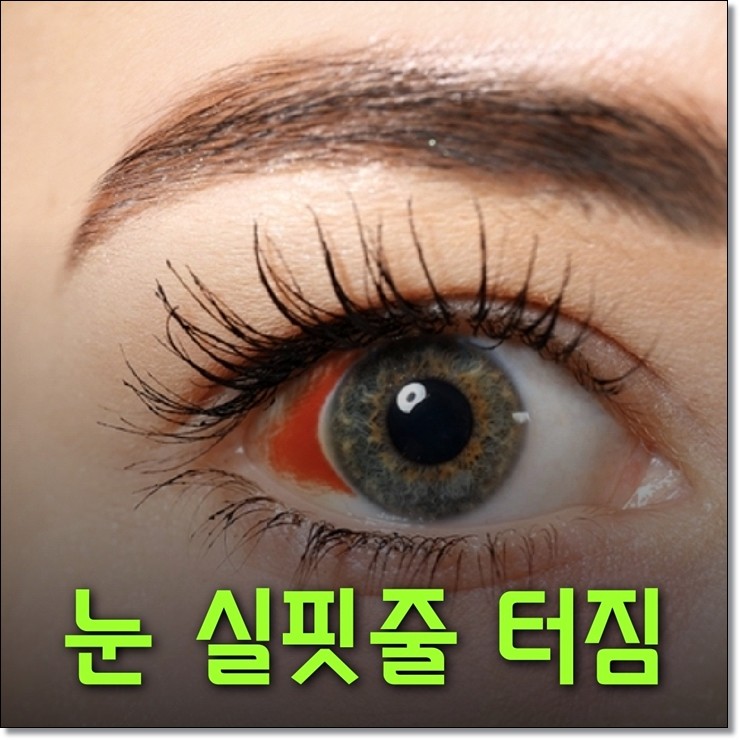눈 실핏줄 터짐 눈충혈 원인과 증상 관리법 체크하세요