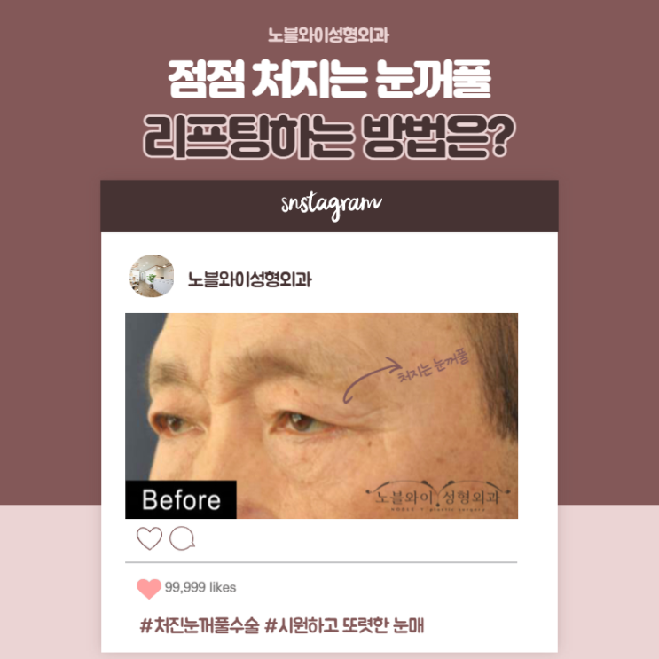  처진눈꺼풀수술 이마, 미간주름도 개선