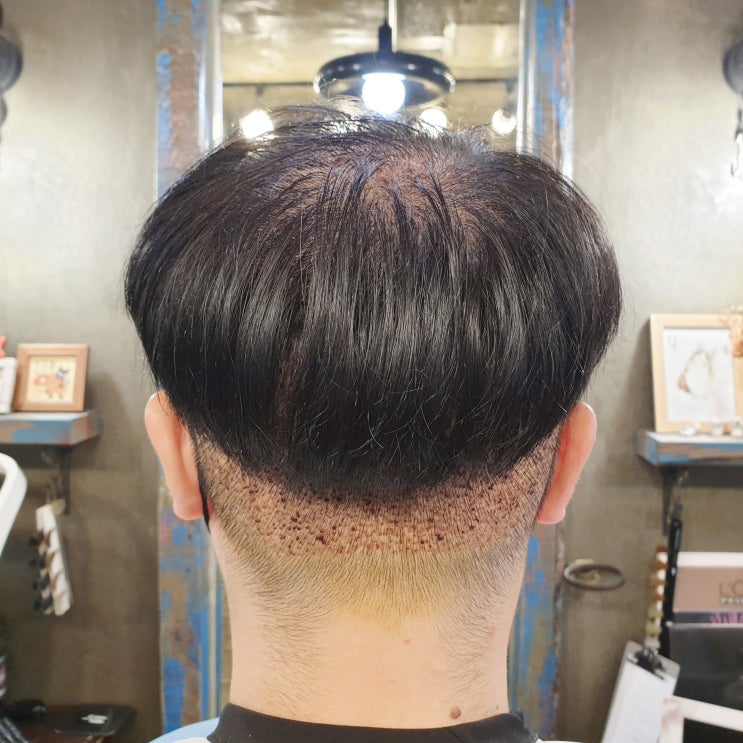  남자헤어라인 심기 전 머리 길이는?