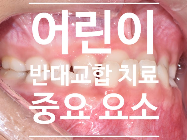 어린이 반대교합 치료의 중요 요소; 치료시기, 유전력, 성장단계, 교합 상태, 협조도, 유지 관리