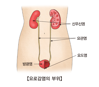  피곤하면 자꾸 재발하는 급박뇨, 빈뇨, 배뇨통 / 만성 방광염