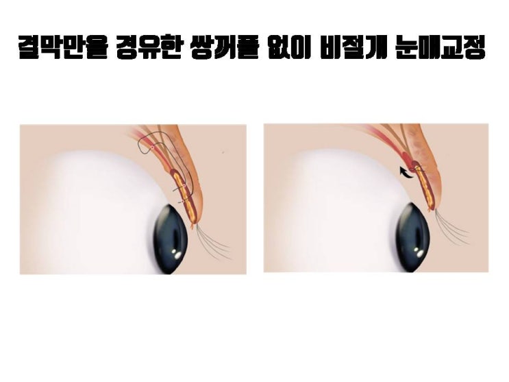  눈매교정을 하는데 무쌍으로 하는 것이 장점이 하나라도 있을까요?
