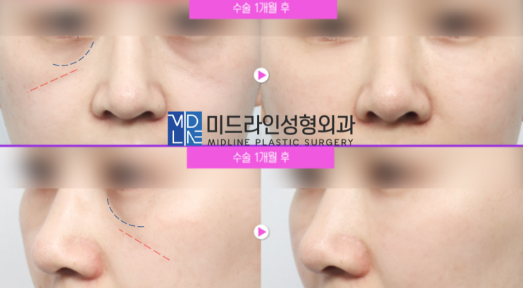  인디언 주름 고민 해결! 미드업리프팅에 대하여 설명드립니다.