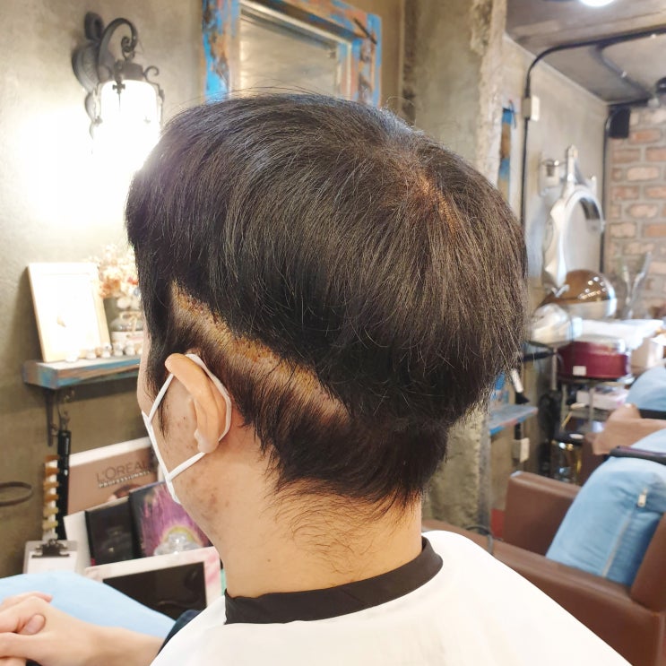  이마축소술과 헤어라인이식 어떤 걸 해야 할까?