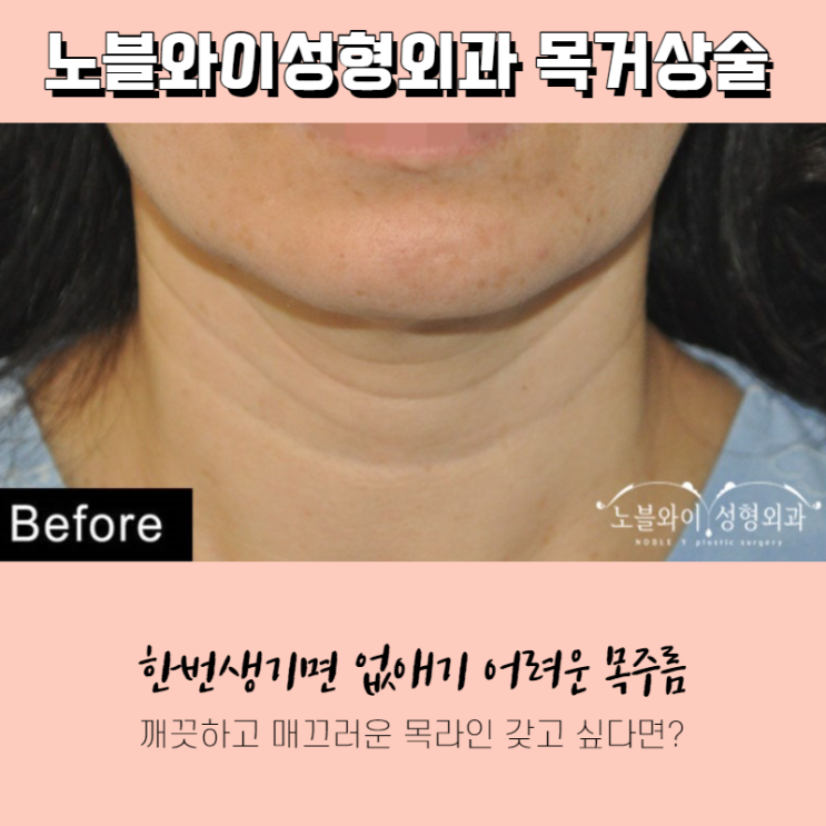 노블와이성형외과 목거상수술 효과 유지기간 길어