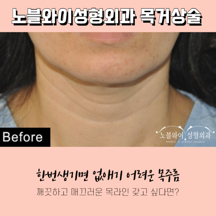  노블와이성형외과 목거상수술 효과 유지기간 길어