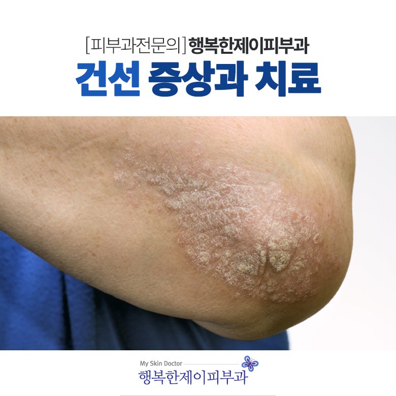 피부각질의 원인 치료방법을 알려드릴게요