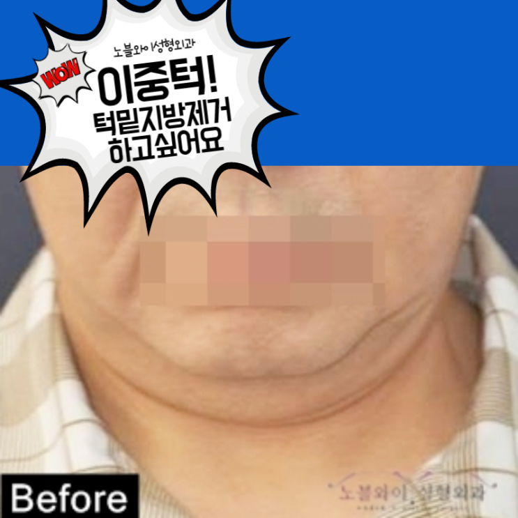  이중턱수술 턱밑지방제거 효과 보셨나요