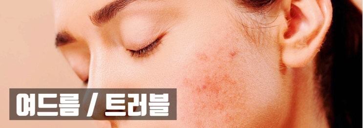  여드름 솔루션 - 메조에스테틱 액니원