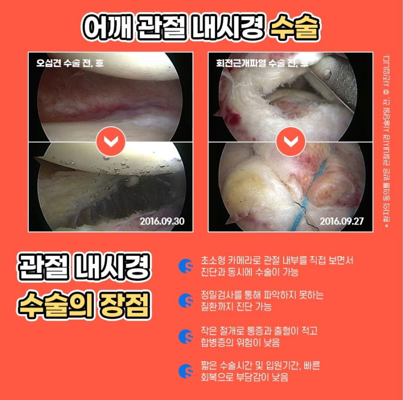 금천구 어깨수술 오십견 큰 고통 준다
