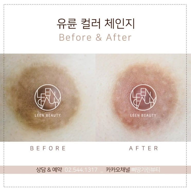  유두 유륜반영구 색깔 모양 흉터커버 고민은 삐땅기린뷰티