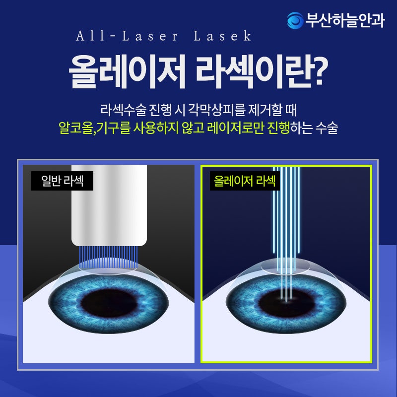 올레이저라섹 기존 라식라섹수술과의 차이점