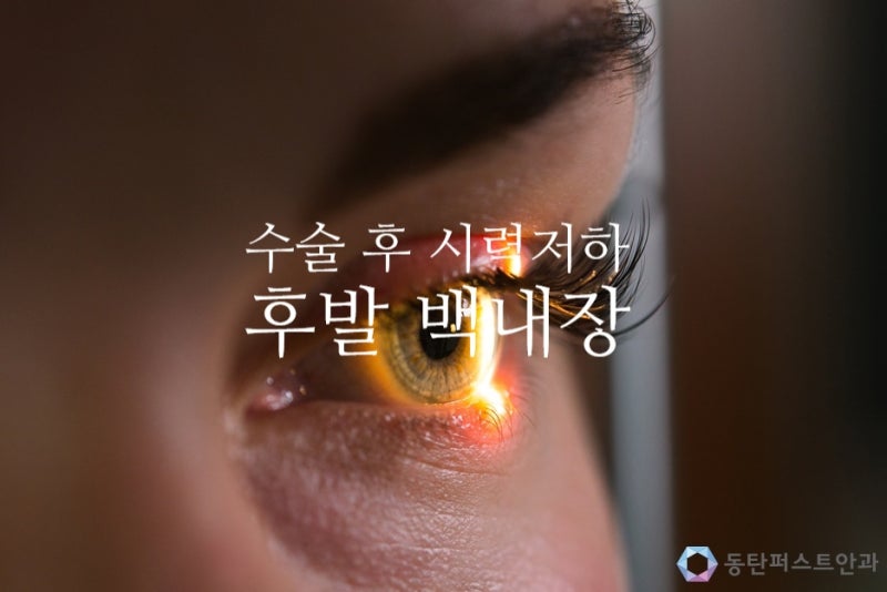 녹내장관리 백내장수술, 후발성 백내장 레이저 시술